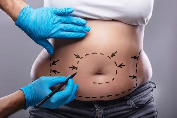 Tummy tuck surgeons; a person with marker marks on the abdomen