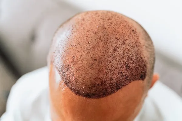 DHI Transplant, photo from above of a person after a hair transplant.