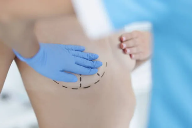 Marked surgical lines outlining the breast lift treatment area.