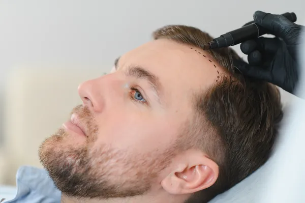Preparation phase of FUT hair transplant with doctor outlining recipient sites.
