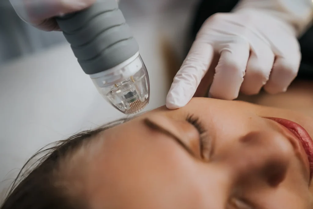 Close-up of a woman receiving the dermapen treatment with a doctor gently touching her face