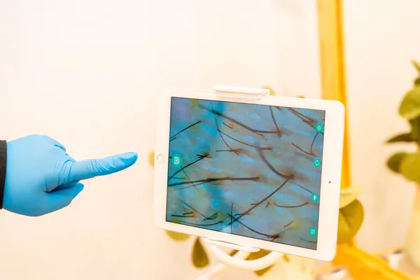 Doctor explaining the DHI hair transplant process with a digital image of donor follicles.