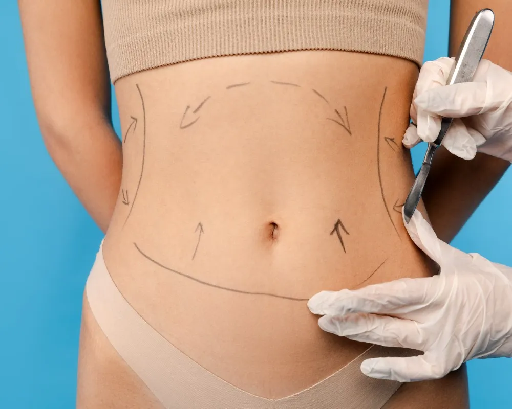 Young woman with surgical markings on her lower abdomen during a preoperative consultation for a mini tummy tuck, representing one of the types of tummy tuck options