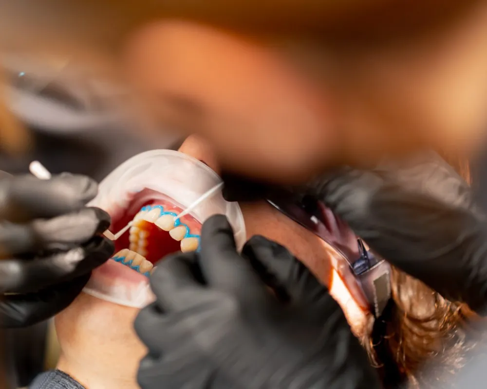 Dentist placing a gum protector on a patient’s mouth to prepare for a cosmetic procedure, illustrating the contrast between dental works vs traditional dental treatments in approach