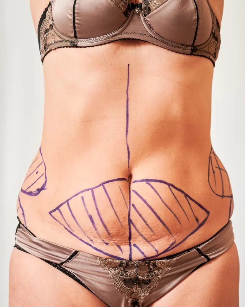 Middle-aged woman showing detailed pre-surgery markings on her torso as part of a tummy tuck plan, used to illustrate differences between types of tummy tuck procedures