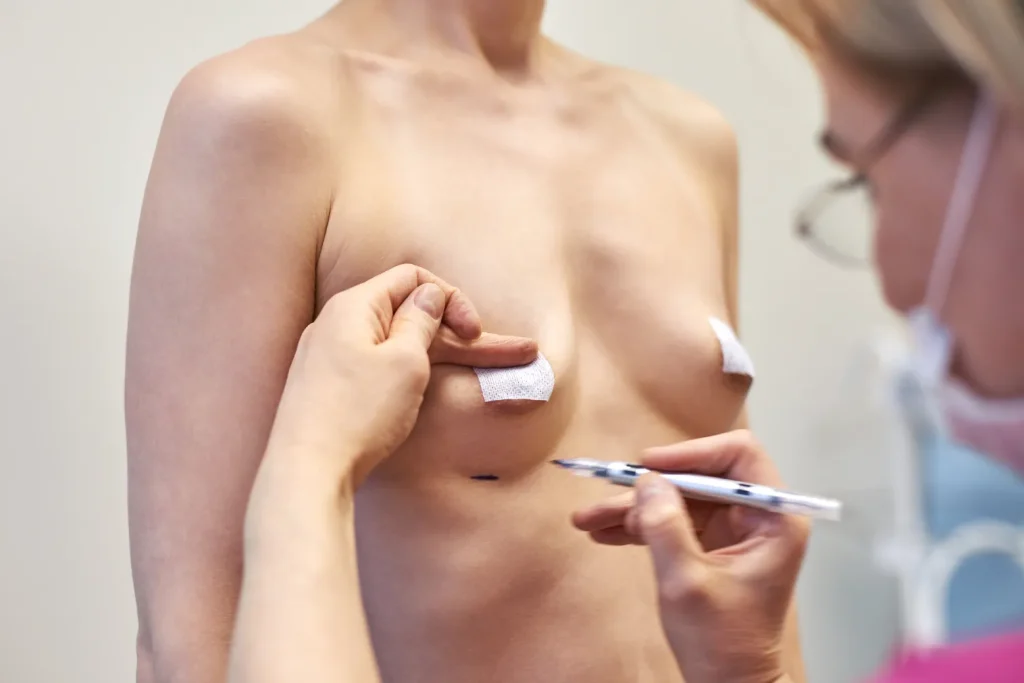 Breast augmentation detailed surgical marking on a female patient by a board-certified plastic surgeon to guide implant placement during cosmetic surgery
