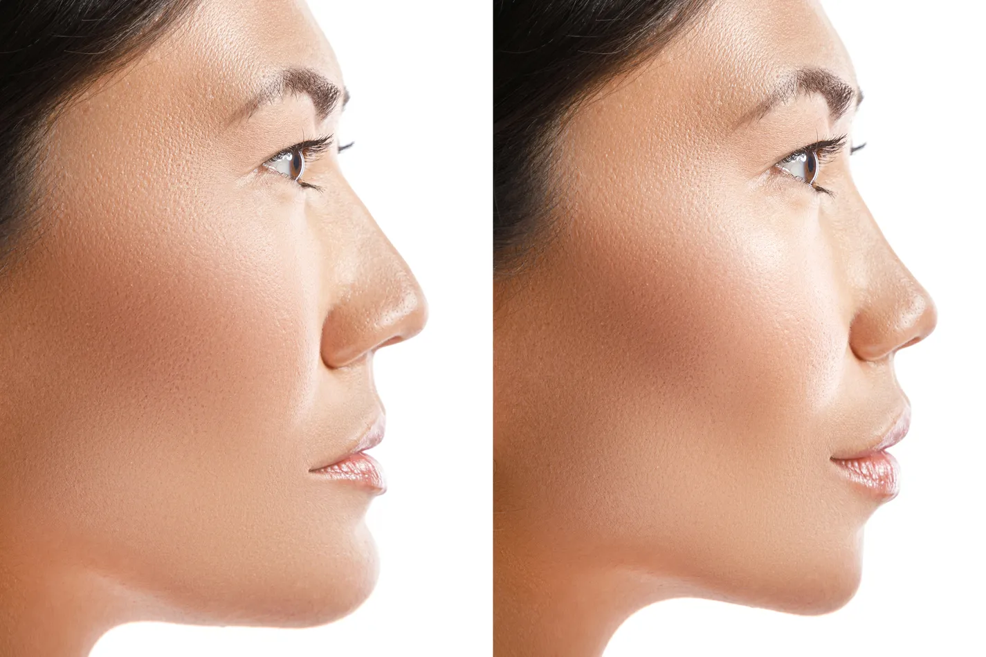 Side profile of a young woman showing significant changes before and after rhinoplasty, highlighting one of the top plastic surgery procedures for facial enhancement