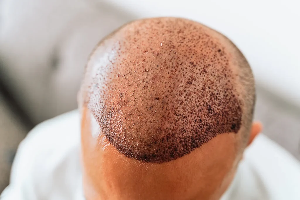 Patient’s head post-hair transplant, showing improved hair density through advanced hair loss solutions