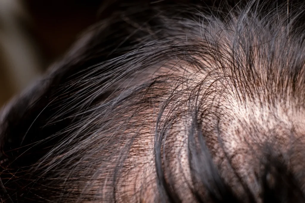 Close-up of a person’s scalp with bald areas, highlighting the need for effective hair loss solutions