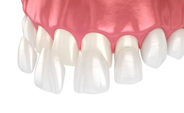 A 3D model of a mouth showing the placement process of dental veneers, highlighting various types of dental veneers available in cosmetic dentistry