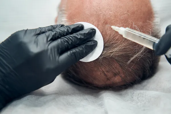 Close-up of a man receiving a scalp injection for hair growth. Enhancing the environment for the Benefits of hair transplant.
