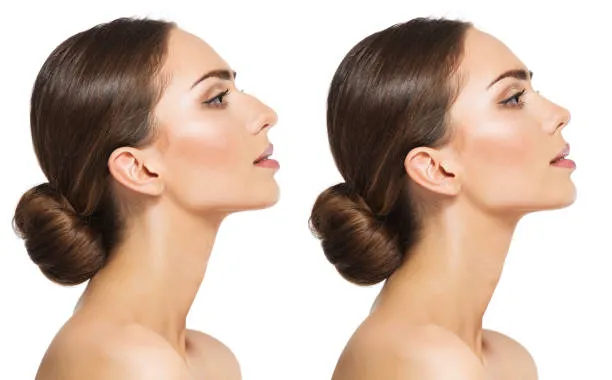Generic comparison visual related to how much does a rhinoplasty cost