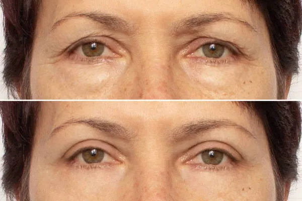 How much does blepharoplasty cost when comparing US and Mexico prices