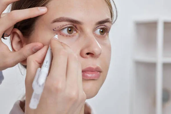 Upper eyelid surgery cost explained for blepharoplasty patients