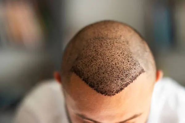 Hair transplant price Mexico based on technique and grafts