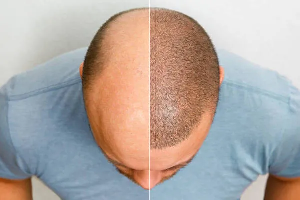 Cost of hair transplant in Mexico depending on graft numbers