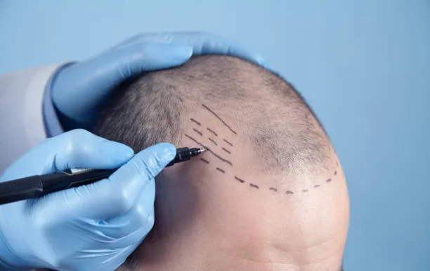 Hair Transplant Requirements You Must Know Before Traveling to Mexico