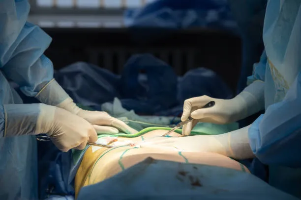abdominoplasty in Cancun performed by a Cancun tummy tuck surgeon