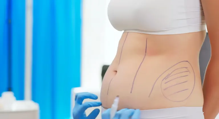 Doctor drawing surgical marks on a woman’s abdomen before performing a liposuction procedure.