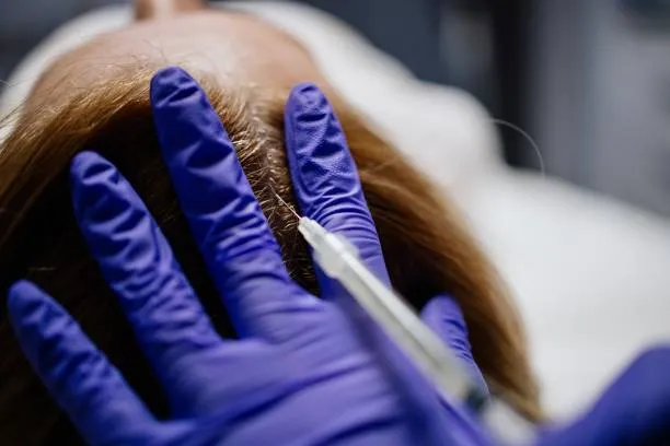 Doctor performing a PRP Injection on a woman’s scalp using a syringe to stimulate hair groDoctor performing a PRP Injection on a woman’s scalp using a syringe to stimulate hair growth.wth.
