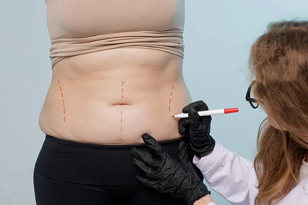 Surgeon marking a patient’s abdomen to plan a precise liposuction treatment.