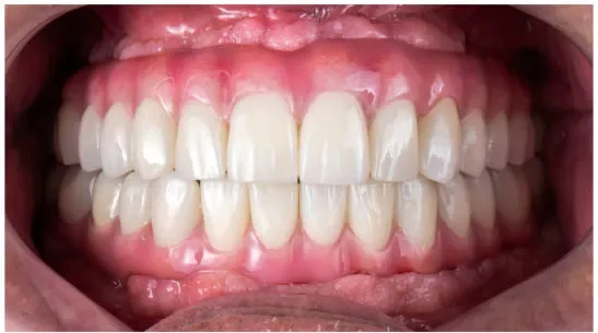 Before and after comparison showing a patient without teeth and the final smile after dental implant treatment.