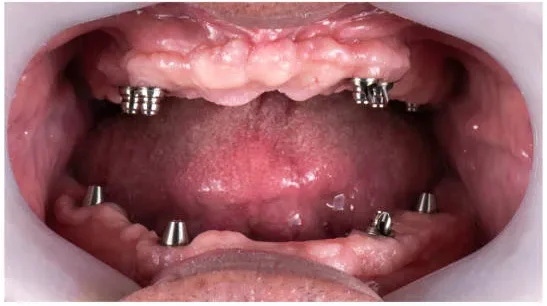 Before and after comparison showing a patient without teeth and the final smile after dental implant treatment.