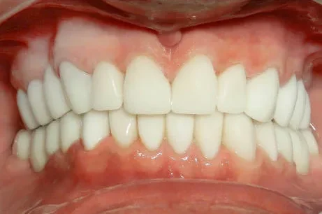Before and after dental transformation showing missing teeth replaced with dental implants for a natural smile