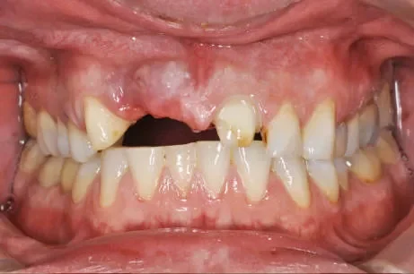 Before and after dental transformation showing missing teeth replaced with dental implants for a natural smile