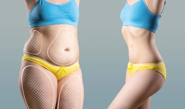 Before and after comparison of a woman’s body showing visible results after liposuction surgery.
