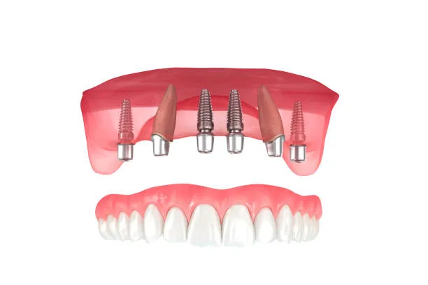 Medical illustration showing dental implants with titanium screws placed in the jawbone to support artificial teeth.