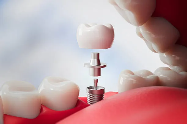 Dental Implants vs Dental Bridges showing a dental implant fused with the jawbone