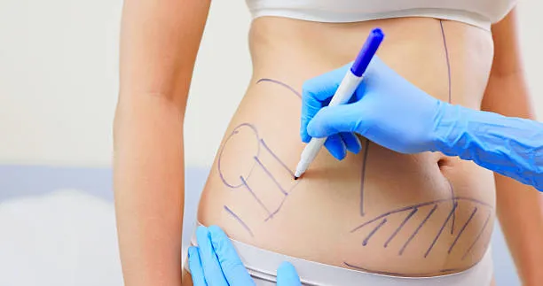 Patient comparing liposuction vs. tummy tuck options for abdominal contouring