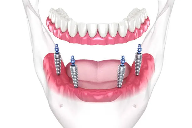 Full-arch dental implants All-on-4 vs All-on-6 Dental Implants treatment in Mexico with fixed implant-supported teeth
