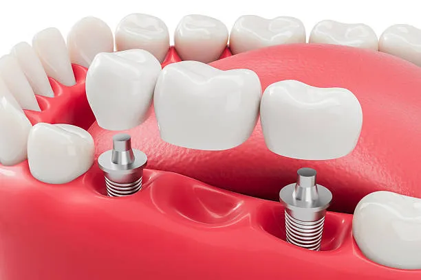 Dental Implants vs Dental Bridges showing a traditional dental bridge