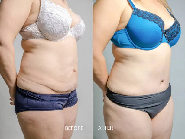 Woman learning the difference between liposuction and abdominoplasty after body changes