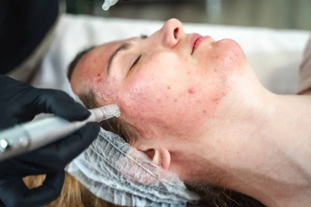 What is Dermapen microneedling used for improving acne scars