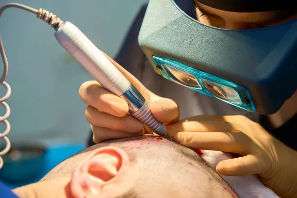 Best hair transplant technique FUE step extraction process