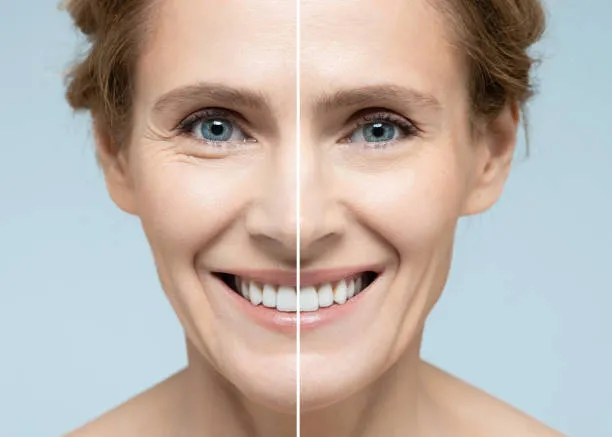 Difference between Botox and dermal fillers showing facial volume restoration with fillers