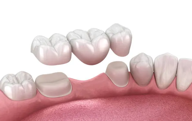Dental Implants vs Dental Bridges comparison for replacing missing teeth