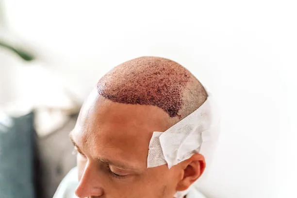 Patient with natural-looking results after a PRP Hair Treatment vs Hair Transplant hair restoration plan in Mexico.