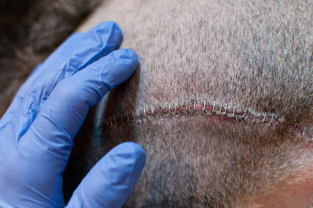 Transplant scar after FUT hair transplant procedure