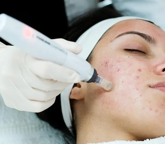 ermapen microneedling treatment being performed to improve the appearance of acne scars and uneven skin texture