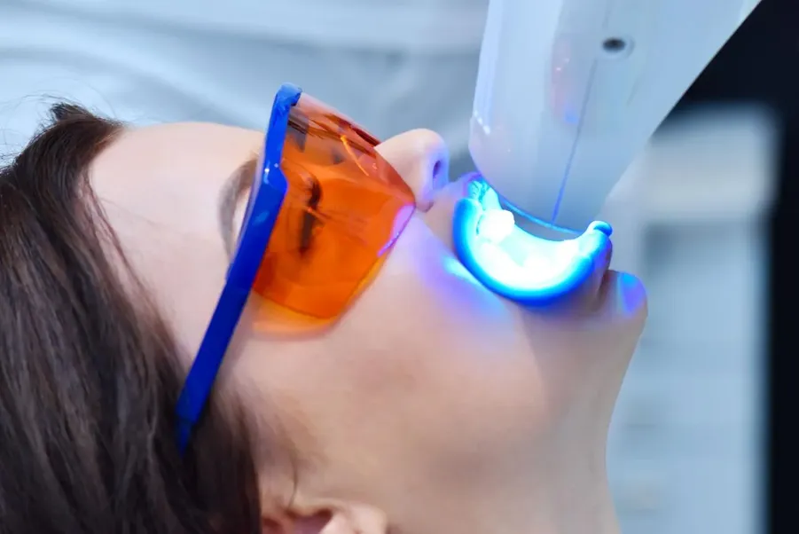 In-office laser teeth whitening treatment performed by a dental professional to brighten natural teeth