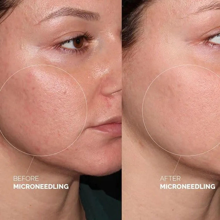 Dermapen results showing smoother skin texture and a more even-looking complexion after microneedling treatment