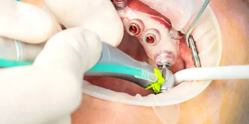 Dentist performing a dental implant surgery procedure as part of a treatment related to dental implants cost and restoration.