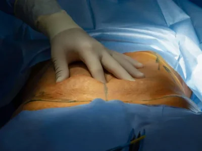 Close-up of a surgical procedure on the abdomen illustrating the medical process and tummy tuck benefits