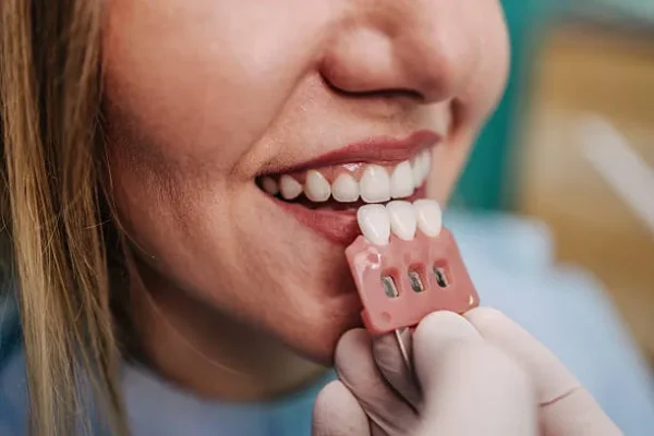 A dentist holding dental veneers in front of a patient’s teeth to choose the right color, illustrating different types of dental veneers