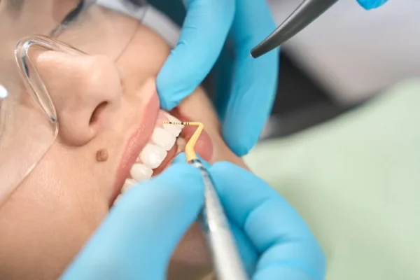 Close-up of a dentist working with a small tool on a patient’s tooth surface during a detailed procedure, representing hands-on techniques in dental works vs traditional dental treatments