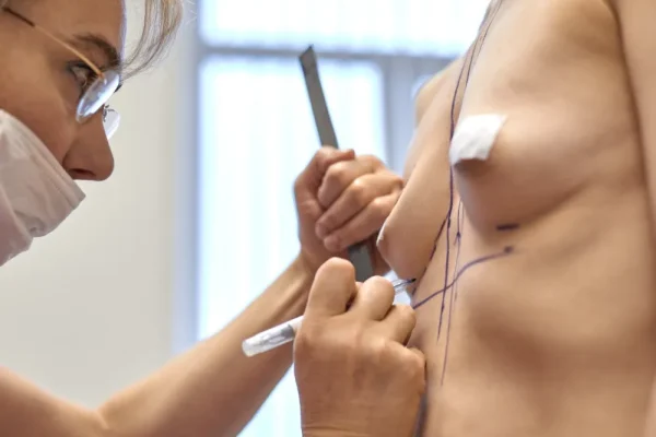 Female doctor marking a patient's breasts during a consultation to prepare for breast augmentation surgery, showing the planning process in breast lift vs breast augmentation procedures
